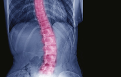 phoenix_scoliosis_surgeons